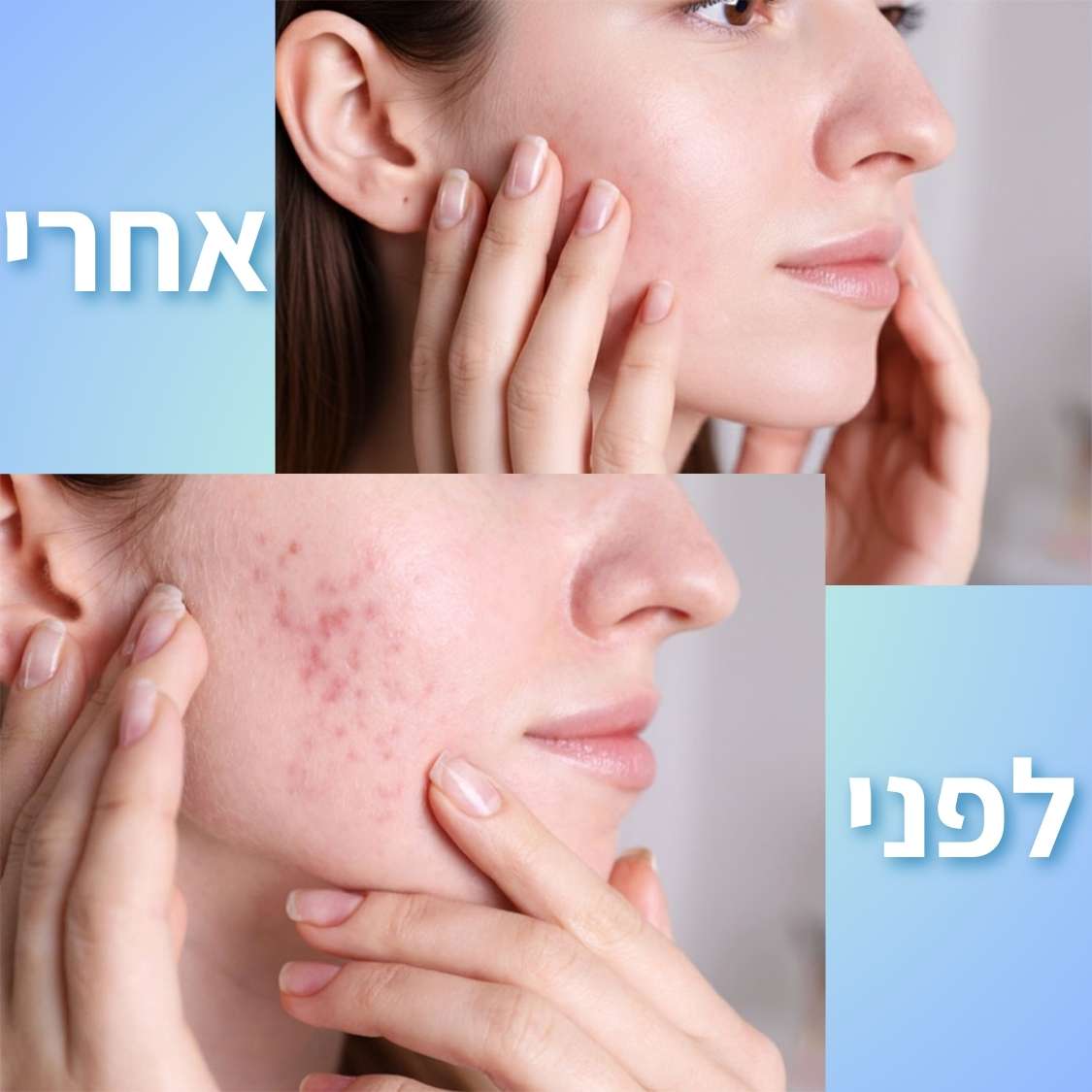 ScarNova | יריעות סיליקון רפואיות לטיפול, טשטוש והחלקת צלקות