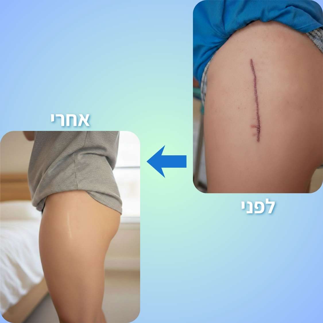 ScarNova | יריעות סיליקון רפואיות לטיפול, טשטוש והחלקת צלקות