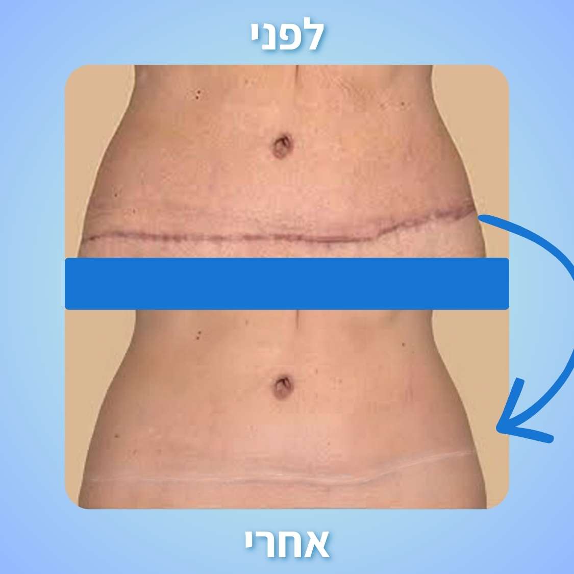 ScarNova | יריעות סיליקון רפואיות לטיפול, טשטוש והחלקת צלקות